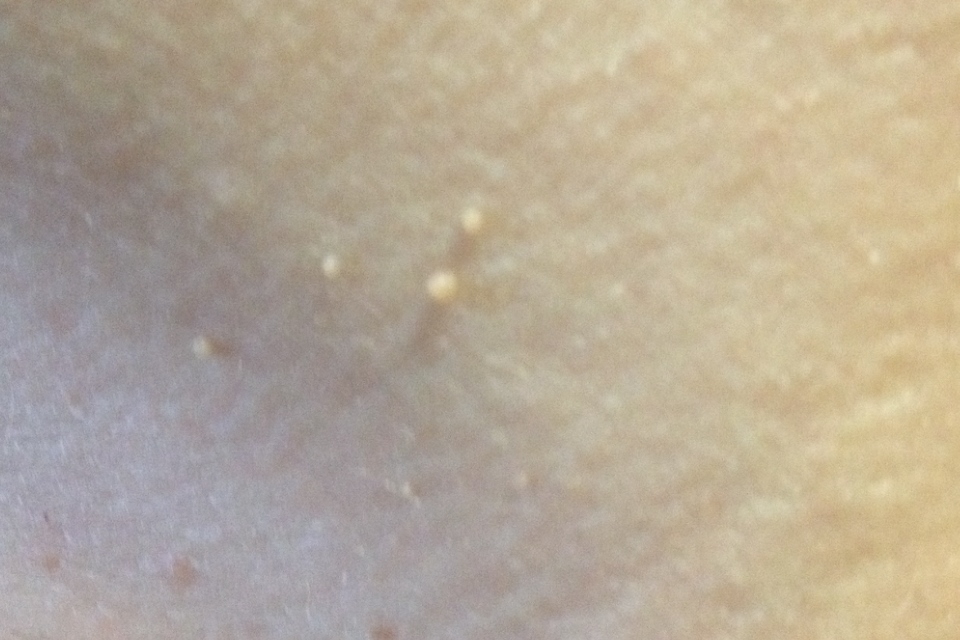 Skin Tag on 45 Year-old Caucasion Woman