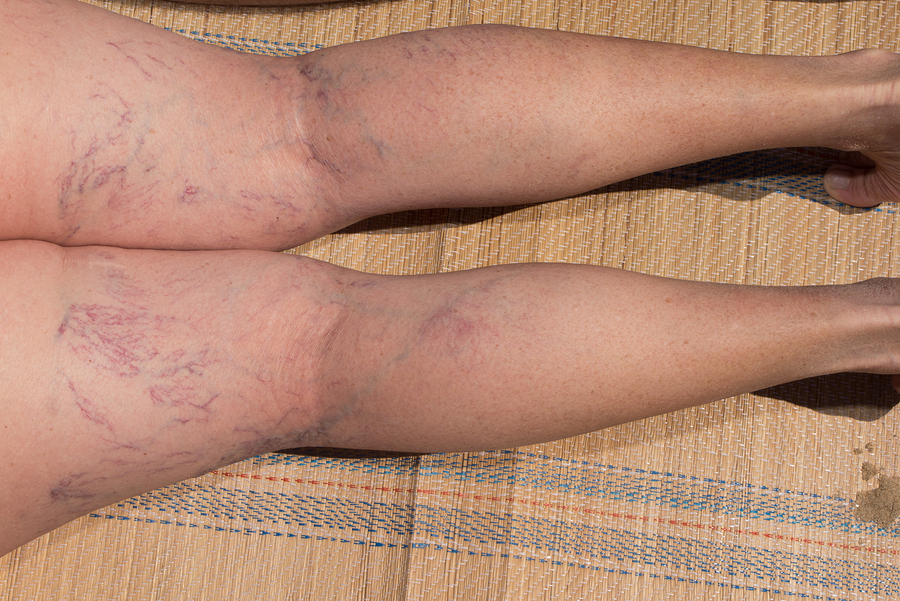 Laser Spider Vein Treatment – What’s the Right Season?