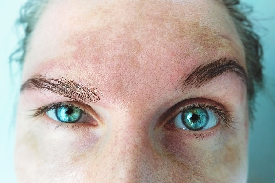 Understanding Hyperpigmentation: Spot Melasma Pigmentation on the face