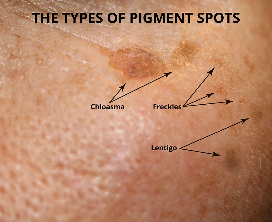 Hyperpigmentation (Brown Spots) - What are the causes? The types of pigment spots on the skin