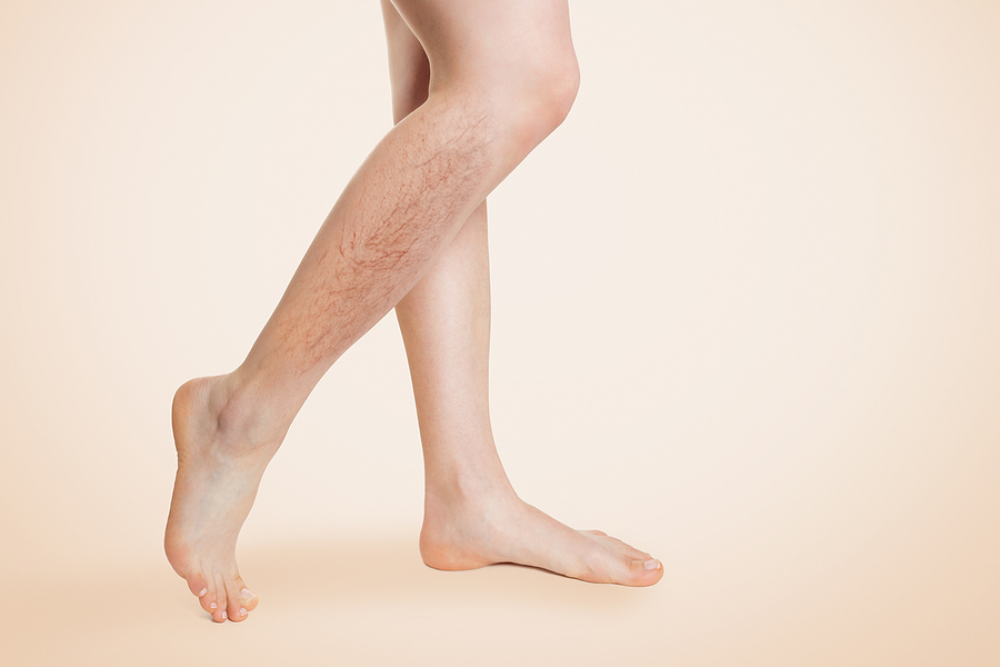 Are You Tired of Your Spider Veins? Spider Veins on Woman's Legs