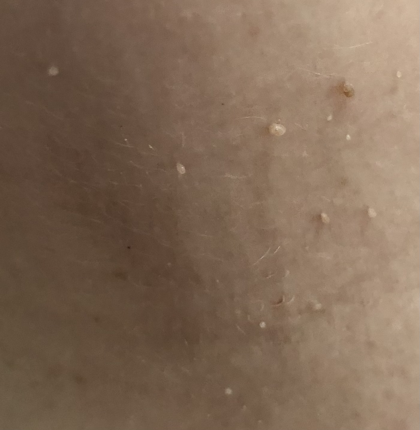 What Causes Skin Tags (Acrochordons)?