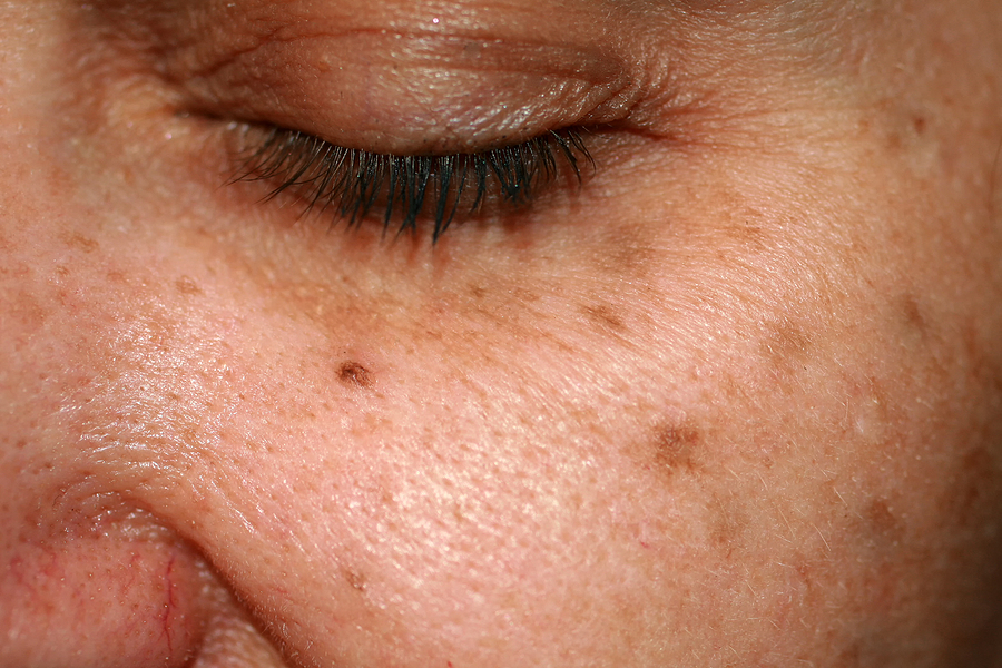 Are Sunspots Serious or Harmless? Brown spots on a woman's cheek.