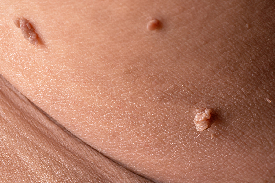 Are Skin Tags (Acrochordons) Common? - Electrolysis By Shelly Blog